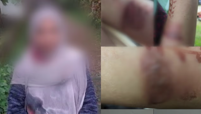 അധ്യാപികയ്ക്കെതിരെ പരാതി ഭിന്നശേഷിക്കാരിയായ യുവതിയുടെ കൈ ചൂടുവെള്ളം ഒഴിച്ച് പൊള്ളിച്ചു,