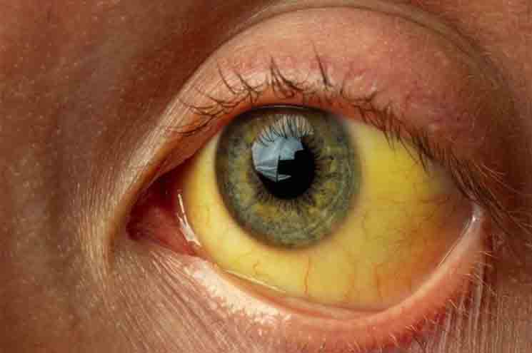 മലപ്പുറത്ത് മഞ്ഞപ്പിത്തം ബാധിച്ച് 14 കാരന്‍ മരിച്ചു; ഇന്ന് രണ്ടാമത്തെ മരണം; ജില്ലയില്‍ അഞ്ച് മാസത്തിനിടെ എട്ടുപേരാണ് മഞ്ഞപ്പിത്തം ബാധിച്ച് മരിച്ചത്. 3000ലധികം കേസുകള്‍ റിപ്പോര്‍ട്ട് ചെയ്തു; ആശങ്കയായി വീണ്ടും മഞ്ഞപ്പിത്തം, എന്താണ് വൈറല്‍ ഹെപ്പറ്റൈറ്റിസ്?; പ്രതിരോധമാര്‍ഗങ്ങള്‍