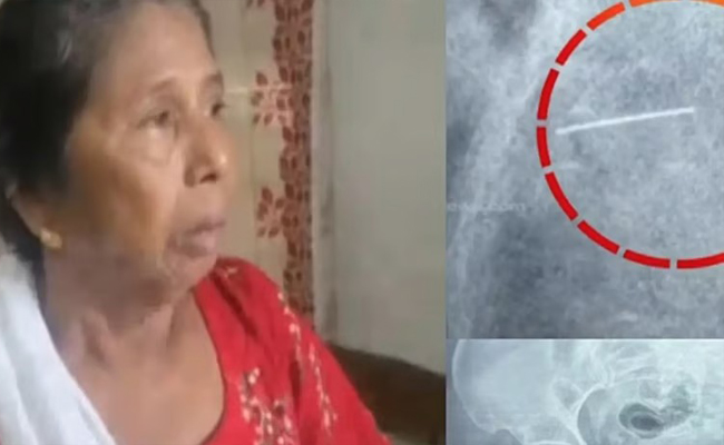 ഒരു വർഷം വീട്ടമ്മ നടന്നത് ഇടുപ്പിൽ ഒടിഞ്ഞിരുന്ന സൂചിയുമായി! പകുതി മാത്രം പുറത്തെടുത്ത് ഡിസ്ചാർജ് ചെയ്തു; ഞെട്ടിക്കുന്ന സംഭവം പത്തനംതിട്ടയിൽ!